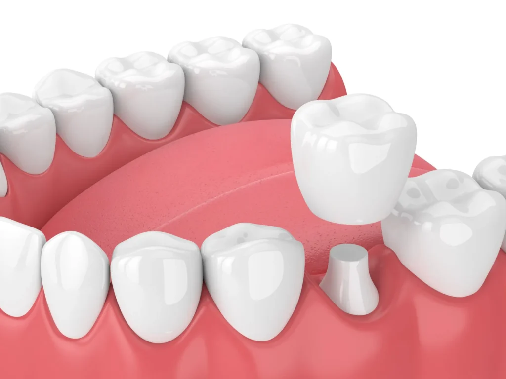 Ceramic Teeth Cap: The Ultimate Solution for a Beautiful and Durable Smile ceramic teeth cap