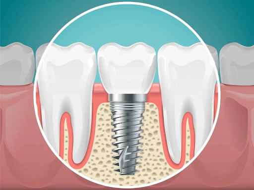 Benefits of Dental Implants for Long-Term Oral Health Dental